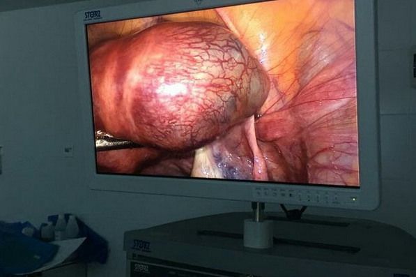 Зеленоградские хирурги прооперировали трех пациенток с внематочной беременностью
